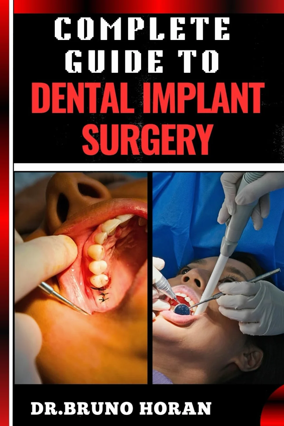 COMPLETE GUIDE TO DENTAL IMPLANT SURGERY: Comprehensive Manual To Advanced Techniques, Recovery, and Best Practices for Optimal Oral Health