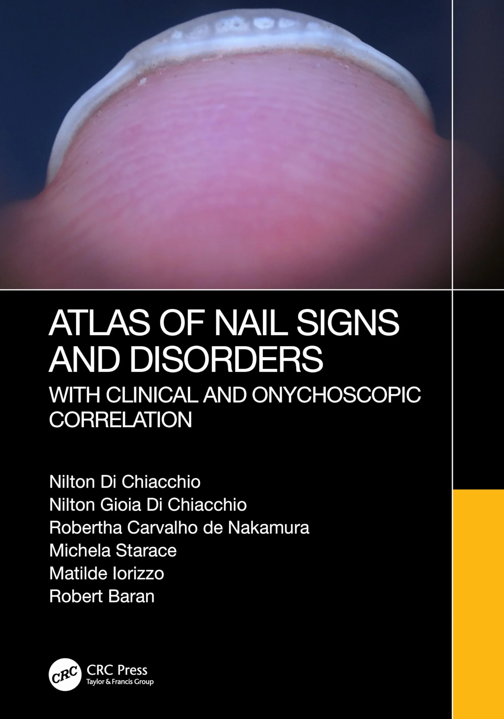 Atlas of Nail Signs and Disorders with Clinical and Onychoscopic Correlation